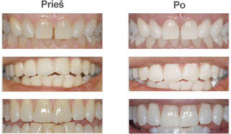 Kas yra dantų balinimas?