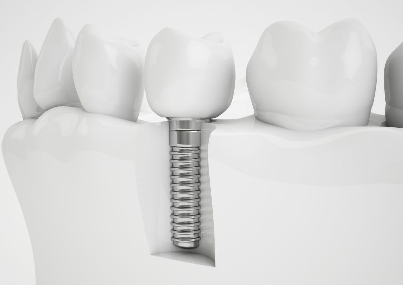 Vienmomentė dantų implantacija – kas tai?