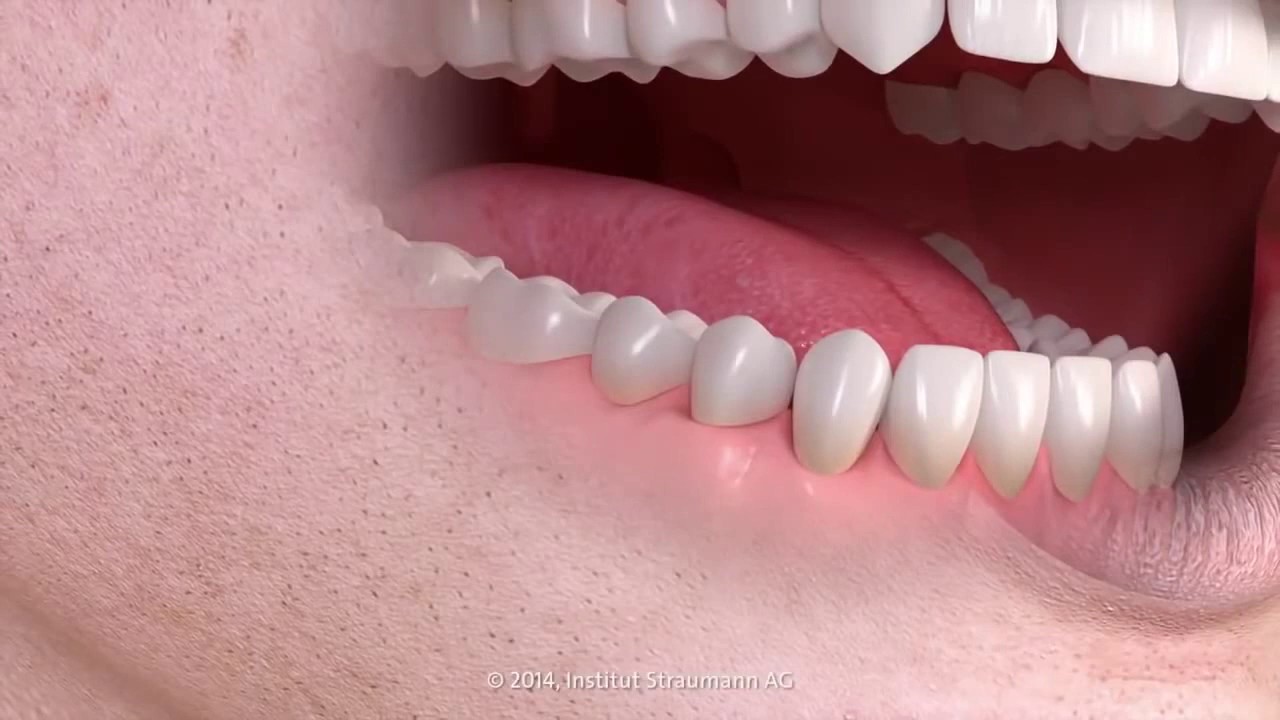 1. Vienmomentė implantacija netekus vieno danties.