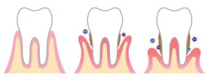 Sukelia dantų ir dantenų ligas